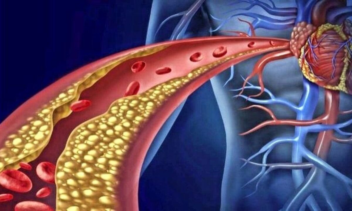 Ilustração artística de uma artéria com placas de gordura